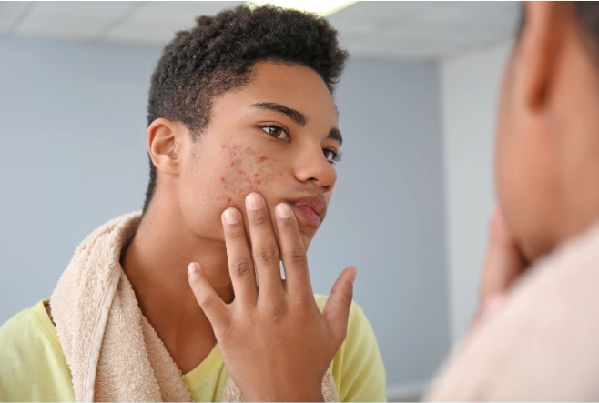 A man looking at the acne on his cheek in the mirror.